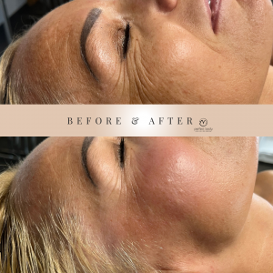 Pomlajevanje obraza maderoterapija